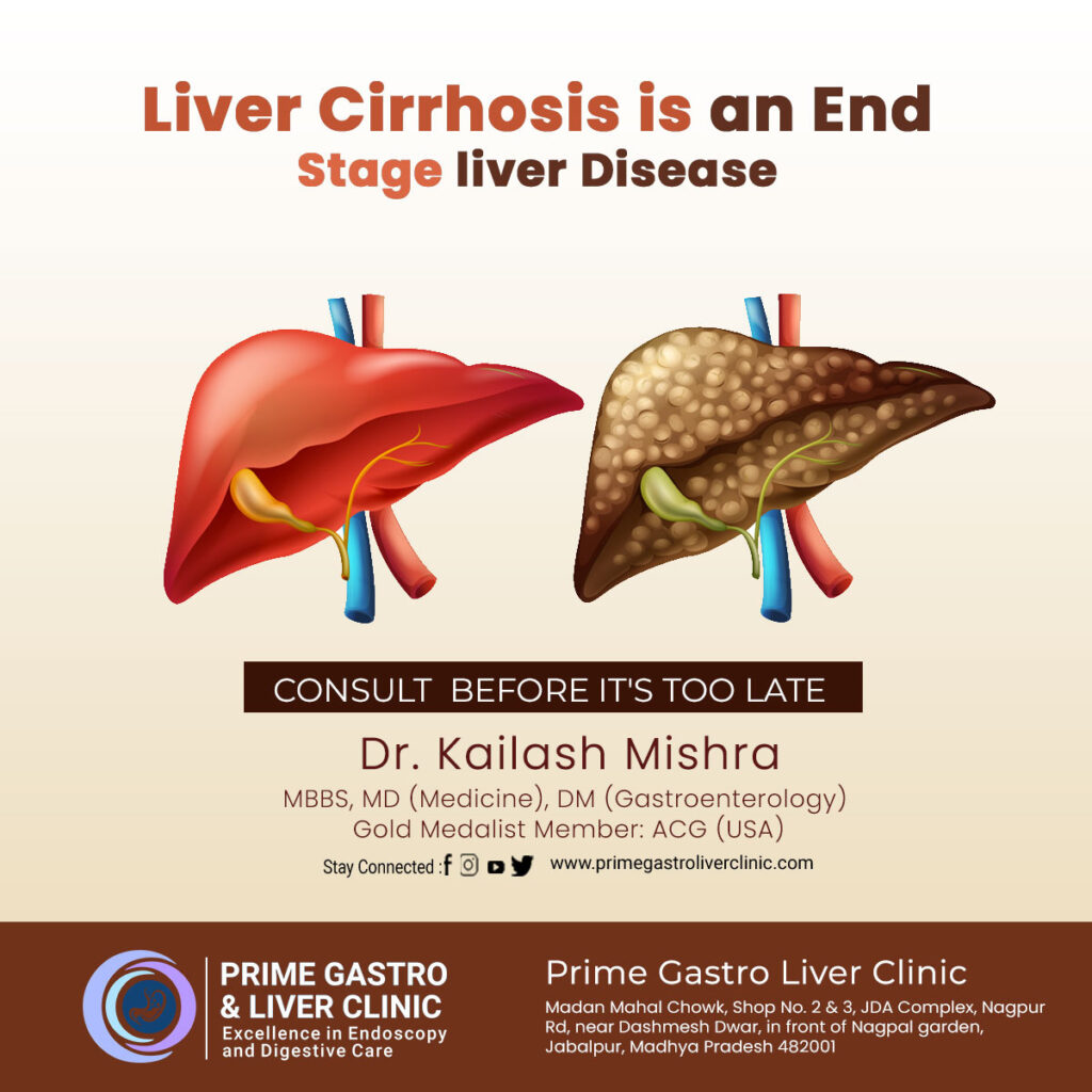 What Is Liver Cirrhosis, Causes, Symptoms, Diagnosing, Treatment & More