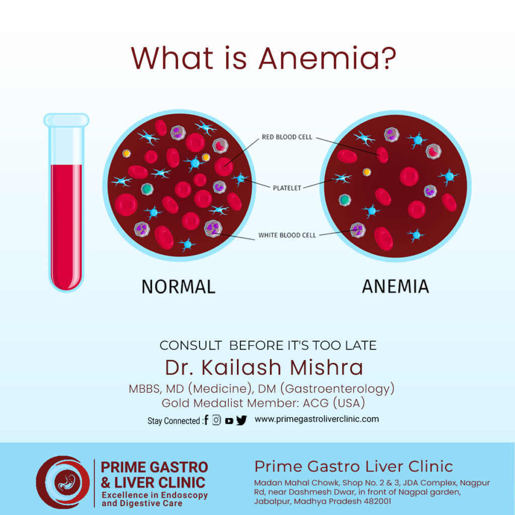 What is Anemia?, Symptoms, Causes, Treatment & More